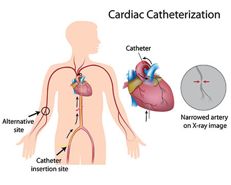 cardiac catheterization